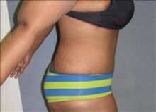Tummy Tuck After Photo by David Abramson, MD; Englewood, NJ - Case 25202