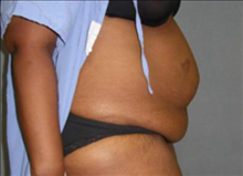 Tummy Tuck Before Photo by David Abramson, MD; Englewood, NJ - Case 25202