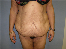 Body Contouring Before Photo by David Abramson, MD; Englewood, NJ - Case 25205