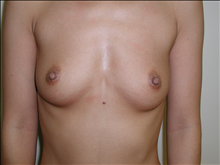 Breast Augmentation Before Photo by David Abramson, MD; Englewood, NJ - Case 25207