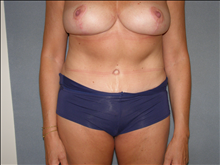 Tummy Tuck After Photo by David Abramson, MD; Englewood, NJ - Case 25295
