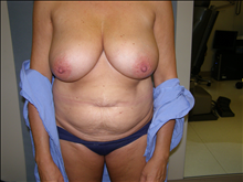 Tummy Tuck Before Photo by David Abramson, MD; Englewood, NJ - Case 25295