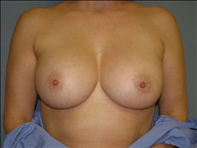 Breast Augmentation After Photo by David Abramson, MD; Englewood, NJ - Case 25297