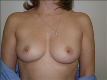 Breast Augmentation Before Photo by David Abramson, MD; Englewood, NJ - Case 25297