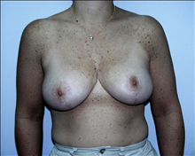 Breast Reduction After Photo by David Abramson, MD; Englewood, NJ - Case 25303