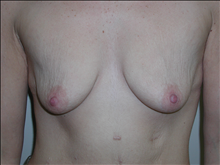 Body Contouring Before Photo by David Abramson, MD; Englewood, NJ - Case 25304