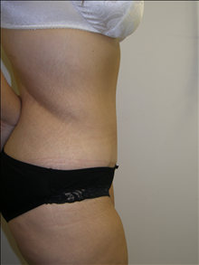 Tummy Tuck After Photo by David Abramson, MD; Englewood, NJ - Case 25305