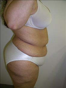 Tummy Tuck Before Photo by David Abramson, MD; Englewood, NJ - Case 25305