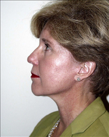 Facelift After Photo by David Abramson, MD; Englewood, NJ - Case 25306
