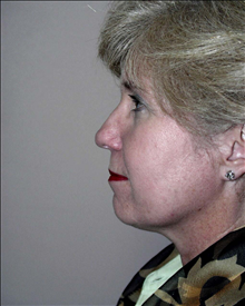 Facelift Before Photo by David Abramson, MD; Englewood, NJ - Case 25306