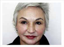 Facelift After Photo by David Abramson, MD; Englewood, NJ - Case 25307