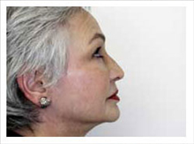 Facelift After Photo by David Abramson, MD; Englewood, NJ - Case 25307