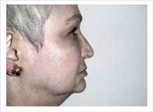 Facelift Before Photo by David Abramson, MD; Englewood, NJ - Case 25307