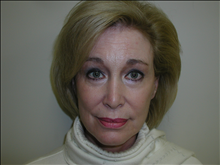 Facelift After Photo by David Abramson, MD; Englewood, NJ - Case 25308