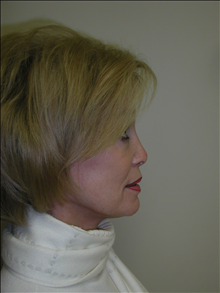 Facelift After Photo by David Abramson, MD; Englewood, NJ - Case 25308