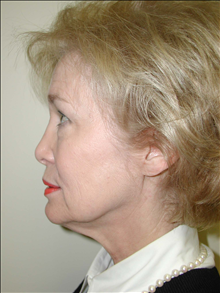 Facelift Before Photo by David Abramson, MD; Englewood, NJ - Case 25308