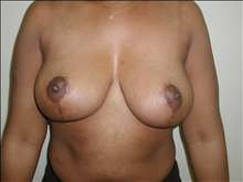 Breast Reduction After Photo by David Abramson, MD; Englewood, NJ - Case 25315