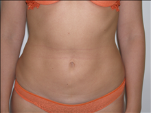 Liposuction After Photo by David Abramson, MD; Englewood, NJ - Case 25318