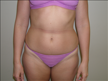 Liposuction Before Photo by David Abramson, MD; Englewood, NJ - Case 25318