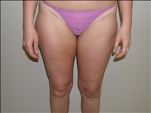 Liposuction Before Photo by David Abramson, MD; Englewood, NJ - Case 25318