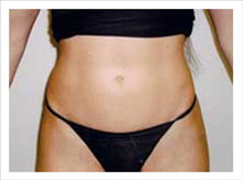 Liposuction After Photo by David Abramson, MD; Englewood, NJ - Case 25319
