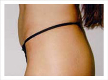 Liposuction After Photo by David Abramson, MD; Englewood, NJ - Case 25319