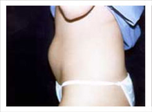 Liposuction Before Photo by David Abramson, MD; Englewood, NJ - Case 25319