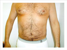 Liposuction After Photo by David Abramson, MD; Englewood, NJ - Case 25320