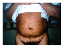 Liposuction Before Photo by David Abramson, MD; Englewood, NJ - Case 25320