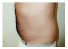 Liposuction After Photo by David Abramson, MD; Englewood, NJ - Case 25320