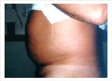 Liposuction Before Photo by David Abramson, MD; Englewood, NJ - Case 25320