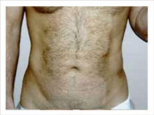 Liposuction After Photo by David Abramson, MD; Englewood, NJ - Case 25321