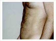 Liposuction After Photo by David Abramson, MD; Englewood, NJ - Case 25321