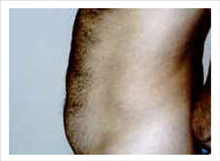 Liposuction Before Photo by David Abramson, MD; Englewood, NJ - Case 25321