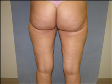 Liposuction After Photo by David Abramson, MD; Englewood, NJ - Case 25322