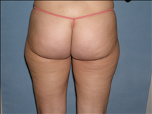 Liposuction Before Photo by David Abramson, MD; Englewood, NJ - Case 25322