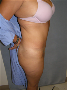 Tummy Tuck After Photo by David Abramson, MD; Englewood, NJ - Case 25326