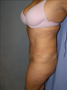 Tummy Tuck After Photo by David Abramson, MD; Englewood, NJ - Case 25326