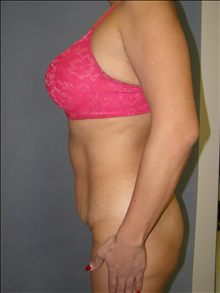 Tummy Tuck Before Photo by David Abramson, MD; Englewood, NJ - Case 25326