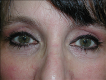 Eyelid Surgery After Photo by David Abramson, MD; Englewood, NJ - Case 25327