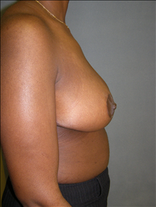 Breast Reduction After Photo by David Abramson, MD; Englewood, NJ - Case 25331