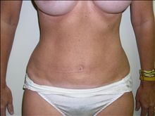 Liposuction After Photo by David Abramson, MD; Englewood, NJ - Case 25333