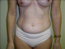 Liposuction Before Photo by David Abramson, MD; Englewood, NJ - Case 25333