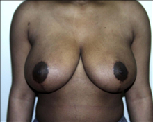 Breast Reduction Before Photo by David Abramson, MD; Englewood, NJ - Case 25336