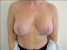 Breast Lift After Photo by David Abramson, MD; Englewood, NJ - Case 25337