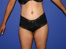 Body Lift After Photo by Larry Leverett, MD; Phoenix, AZ - Case 28520