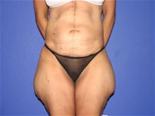 Body Lift Before Photo by Larry Leverett, MD; Phoenix, AZ - Case 28520