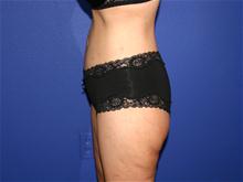 Body Lift After Photo by Larry Leverett, MD; Phoenix, AZ - Case 28520