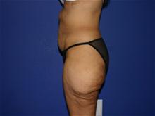Body Lift Before Photo by Larry Leverett, MD; Phoenix, AZ - Case 28520