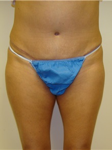 Tummy Tuck After Photo by Michael Malczewski, MD; Hobart, IN - Case 20845